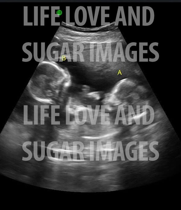 twins ultrasound