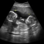 twins ultrasound