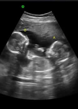 twins ultrasound