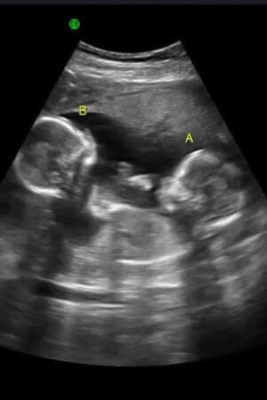 twins ultrasound