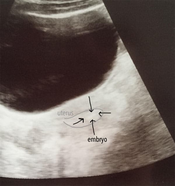 The IVF Transfer Process An Ultrasound Image of the Embryo in Lindsay's Uterus